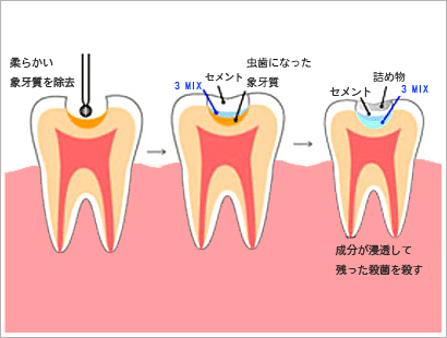 3mix法