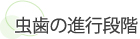 虫歯の進行段階