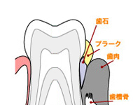 歯周病の発生の要因
