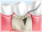 歯石・感染した歯ぐきの除去