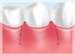 歯ぐきを縫合