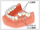 噛める歯を再び手に入れる～インプラント～